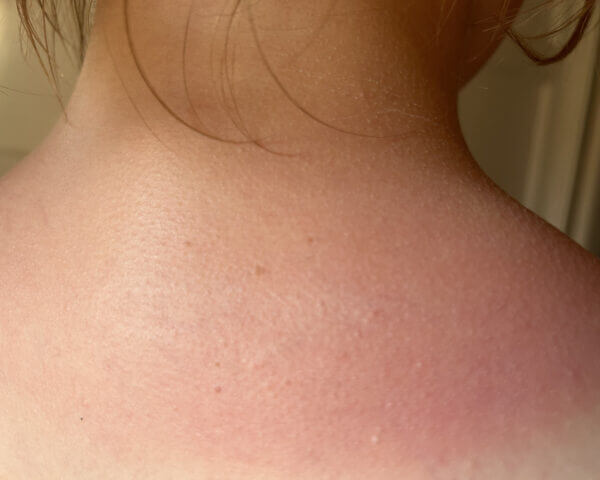 Close-up of the back of a neck with slight redness and small freckles. The skin appears slightly flushed, indicating possible mild sunburn or irritation.