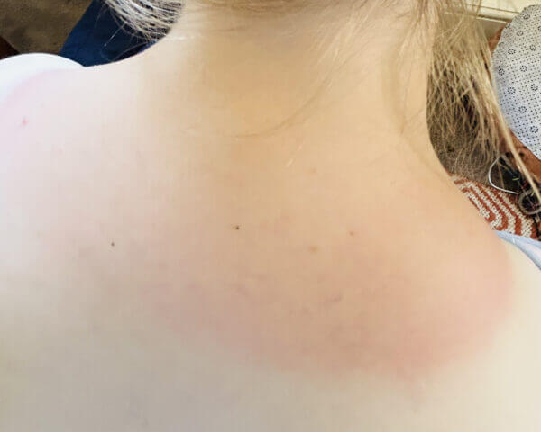The image shows the back of a person's neck and shoulders. The person has fair skin with tan lines and slight redness on the shoulders.