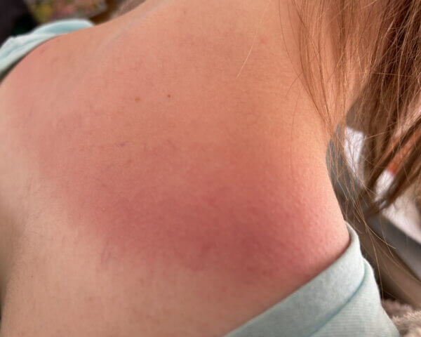 Close-up photo of a person's shoulder showing red, sunburned skin. The redness extends across the shoulder and upper back, with a few freckles visible. The person is wearing a light blue garment that has been pulled to the side.